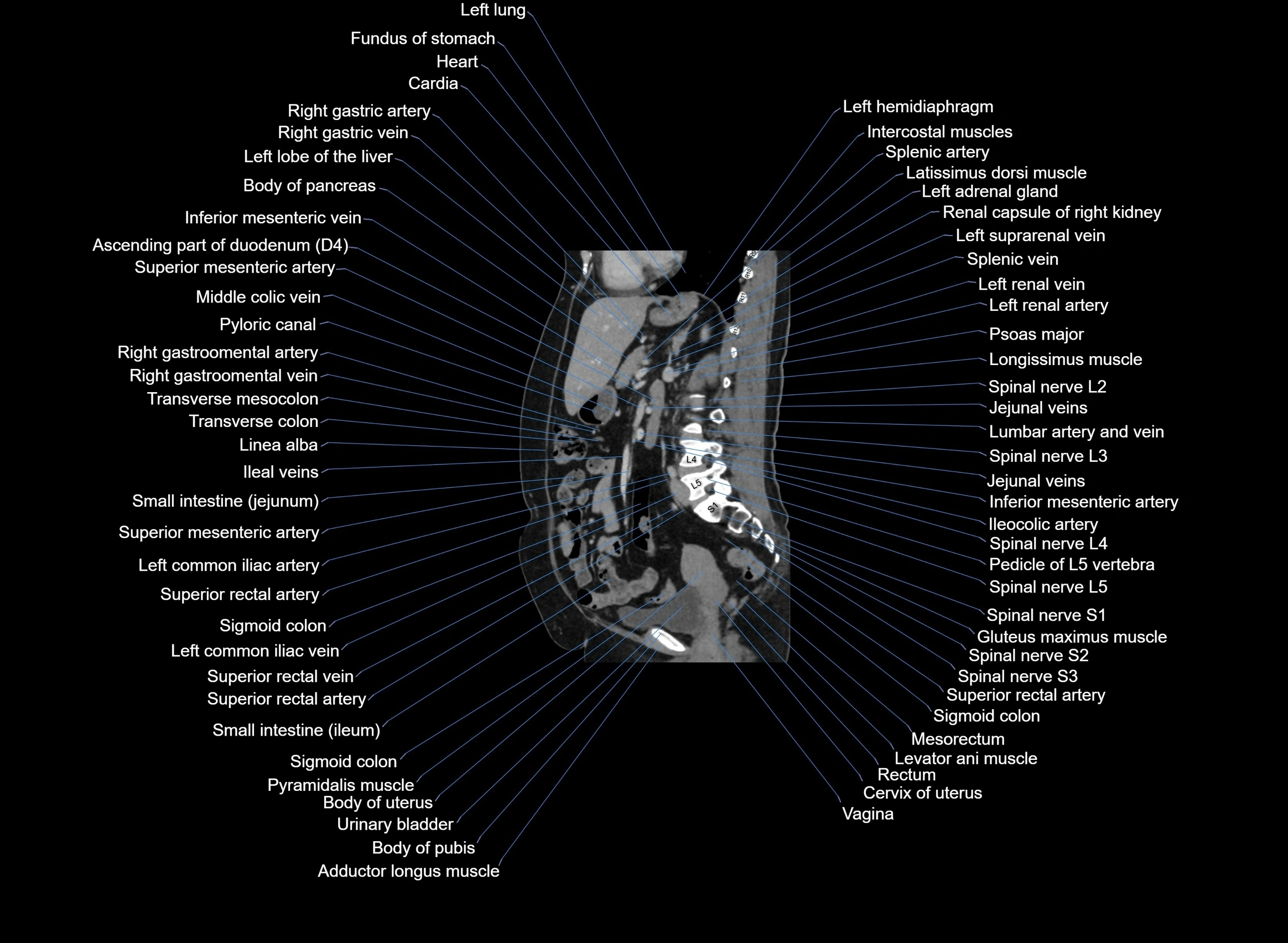 CT Abdomen sagittal cross sectional anatomy labelled radiology image -00053.webp